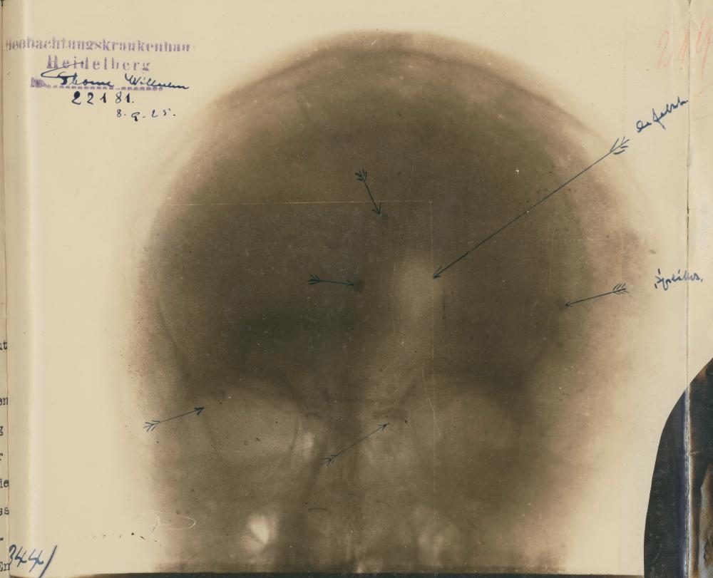 Röntgenbild von Wilhelm Thome aus dem Jahr 1925, das die in seinem Gehirn steckengebliebenen Metallsplitter zeigt. Sie konnten nicht entfernt werden. (Quelle: Landesarchiv BW, GLA 444 Zugang 1997-66, Nr. 51 )